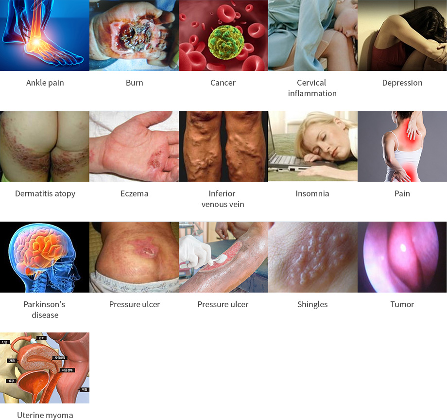 Ankle pain, Burn, Cancer, Cervical inflammation, Depression, Dermatitis atopy, Eczema, Inferior venous vein, Insomnia, Pain, Parkinson's disease, Pressure ulcer, Pressure ulcer, Shingles, Tumor, Uterine myoma